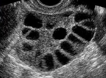 Conteo Folicular